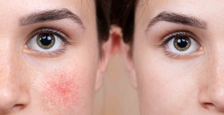 Couperose / Rosacea